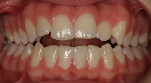 روشهای درمان اوپن بایت