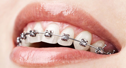 براکت دیمون چیست؟