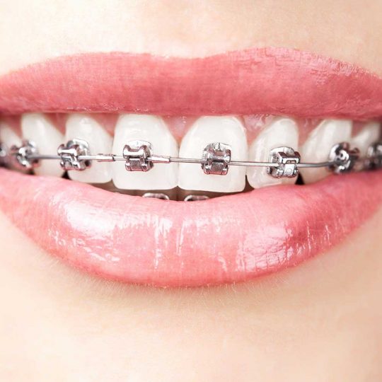 فواید براکت فلزی