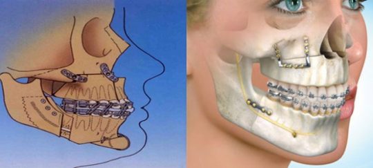 جراحی اصلاحی فک در درمان ارتودنسی