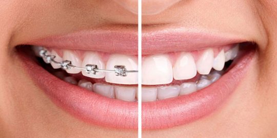 چند نوع درمان ارتودنسی وجود دارد؟